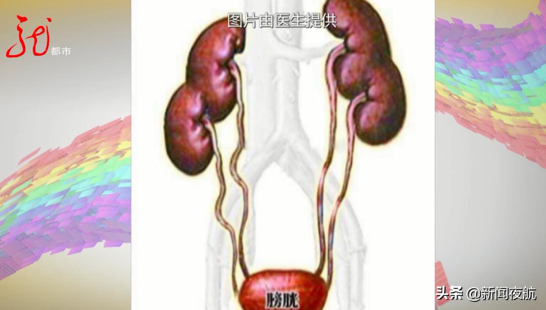 5岁女孩整天穿着尿不湿,每天总是尿不完,检查发现竟然长了三个肾