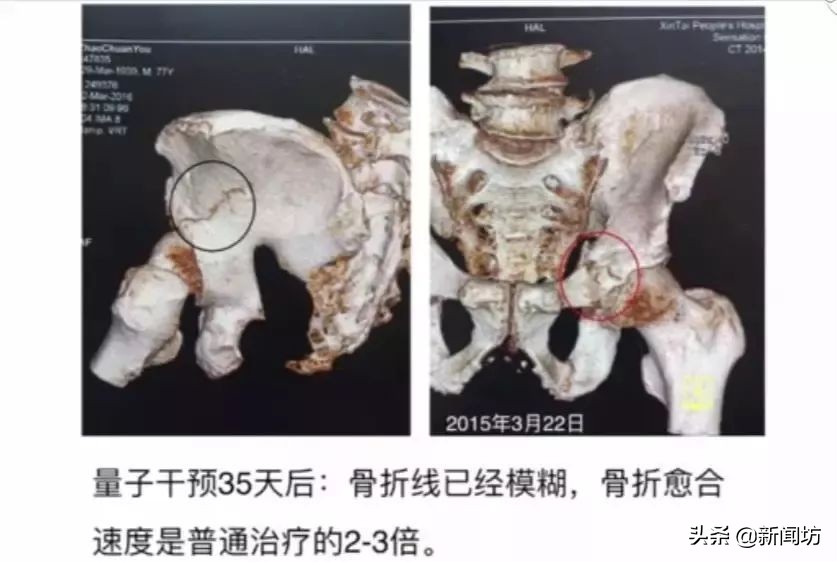 量子速读out了？！有人能拍照治骨折，量子接骨术了解下…