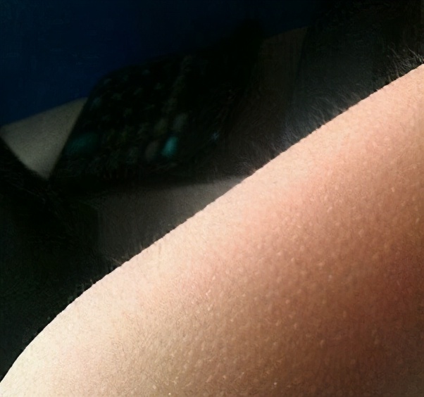 毛发脱毛,哪种脱毛才是永久性脱毛