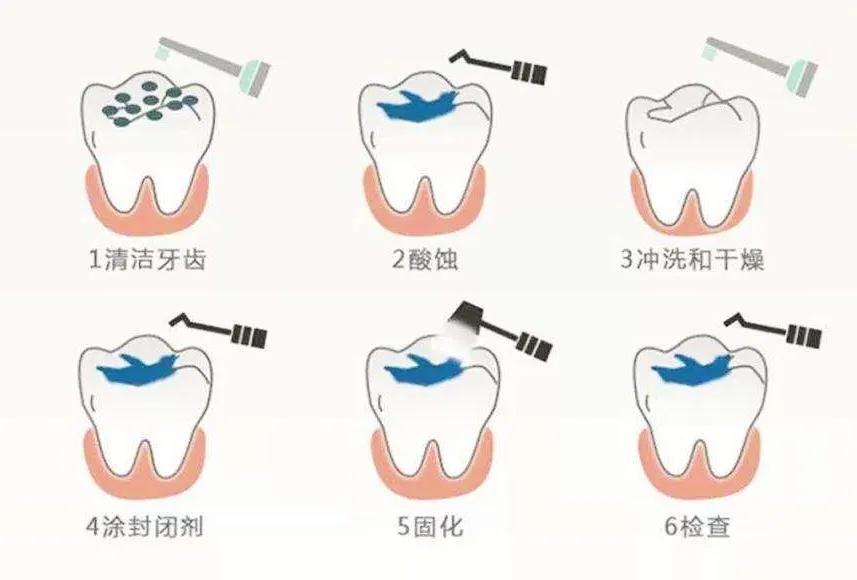 牙科医生检查小朋友口腔,口腔门诊免费窝沟封闭申请