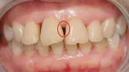 矫正牙齿后一定会出现“黑三角”?形成黑三角的2个原因,注意防范