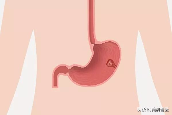 六个胃癌前病变，得了胃病不可再忽视