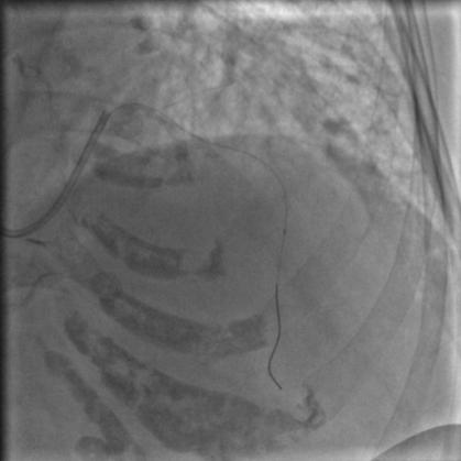 85岁老人心脏堵塞,77岁老人冠脉狭窄放支架还是搭桥
