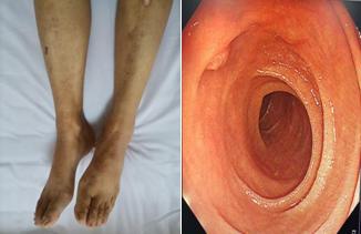 过敏性紫癜腹痛休克,过敏性紫癜剧烈腹痛