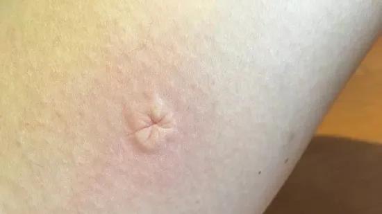 嗡嗡嗡！痒痒痒！招蚊子的宝宝怎么办？夏季驱蚊这样做…