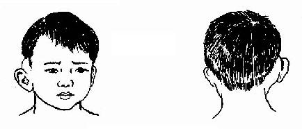 严重的儿童中耳炎——一个有惊无险的小故事