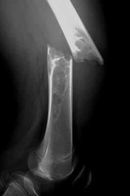 骨折后怎么防止移位,骨折后如何避免骨质疏松