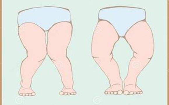孩子腿不直xo型腿,小孩腿o型腿是怎么导致的