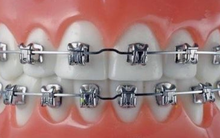 牙齿矫正可以改变脸型吗,牙齿矫正对脸型变化大吗