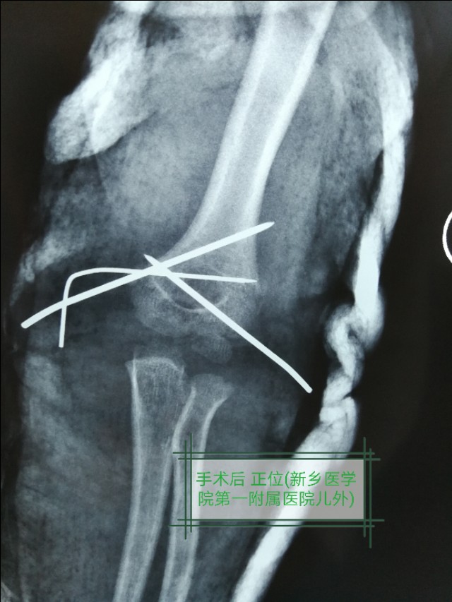 骨折的微创手术有后遗症吗,骨折的微创手术需要多少钱