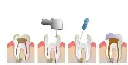 大连口腔视频,大连市口腔医院根管治疗