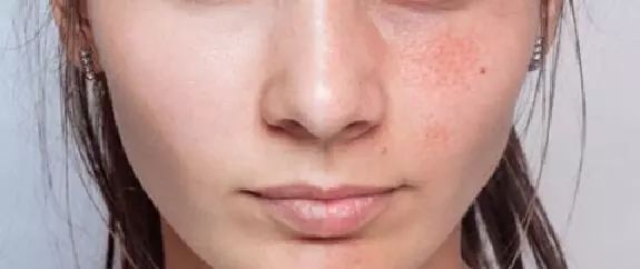 用了果酸后粉刺变白了,果酸护肤后出粉刺