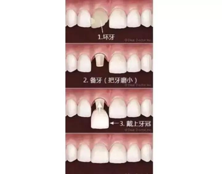 明星的牙都是真牙吗,如何辨别优秀的牙医