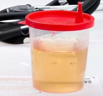 十月怀胎甚是不易,怀孕产检为什么每次都要尿检