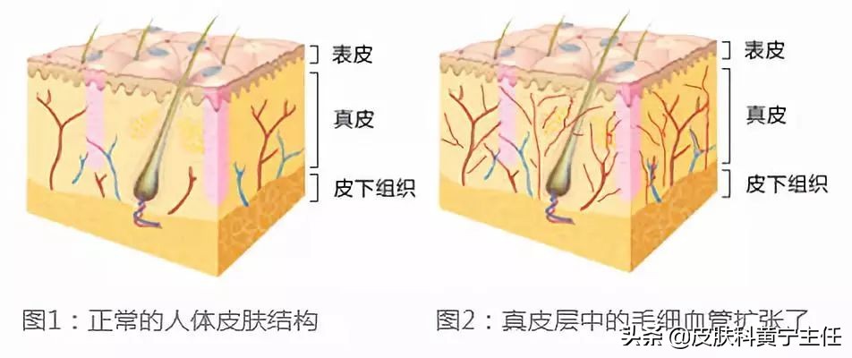 血丝过多怎么缓解,血丝病最佳治疗方法