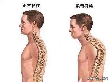 运动操改善驼背教程,改善圆肩驼背运动