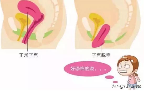 大笑咳嗽会流尿咋办,大笑咳嗽就会漏尿怎么回事