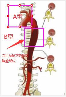 主动脉夹层术后八年再次撕裂,主动脉夹层撕裂不治疗能活多久