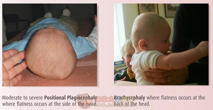 宝宝头睡偏了可以平睡纠正吗,头偏长的宝宝怎么睡头型