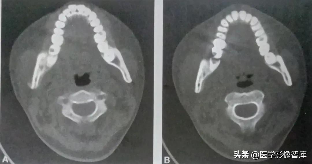牙源性颌骨骨髓炎x线诊断,牙源性上颌骨骨髓炎很严重吗