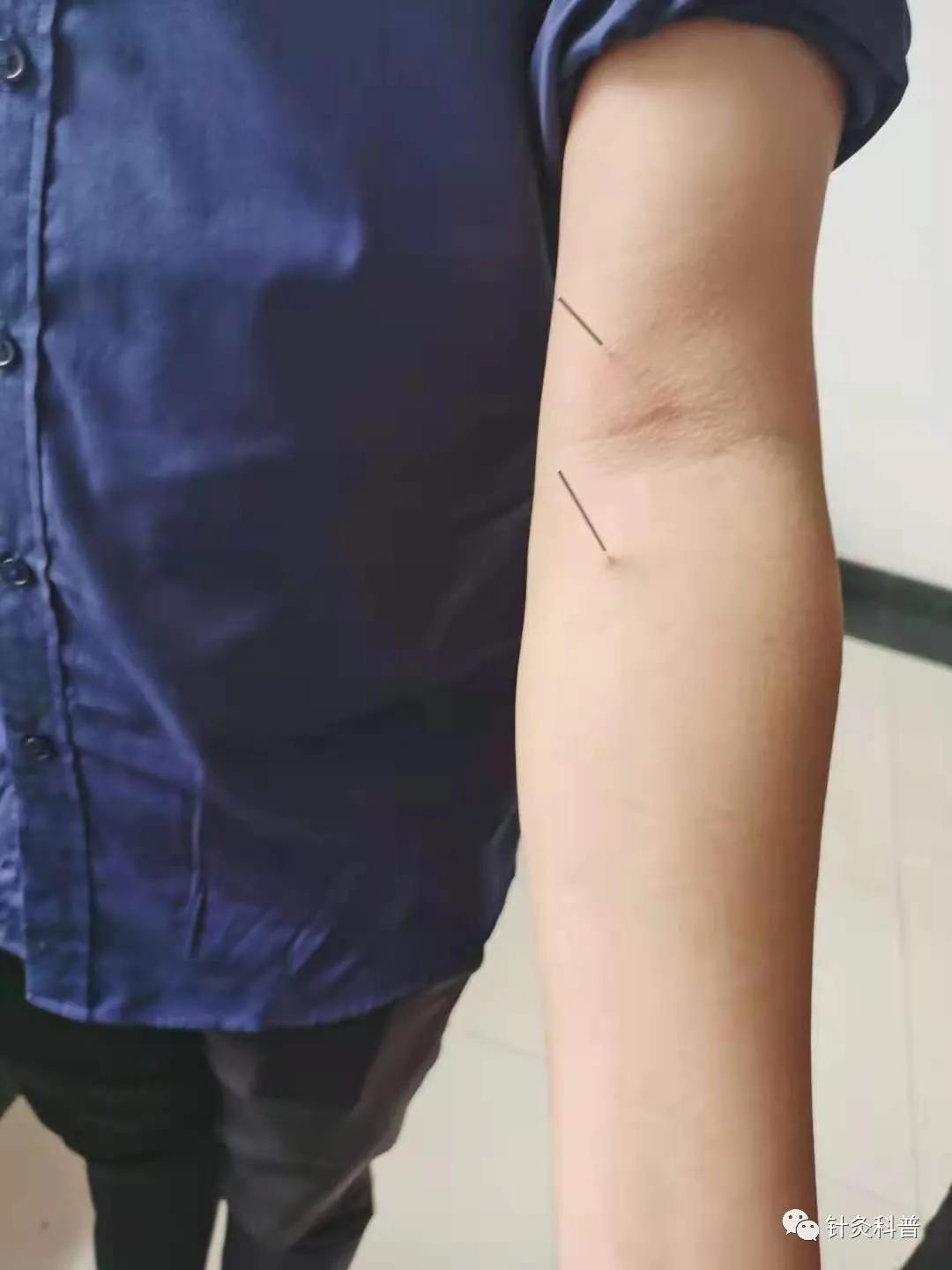 针灸治疗常见疾病方法,伤寒杂病论和针灸