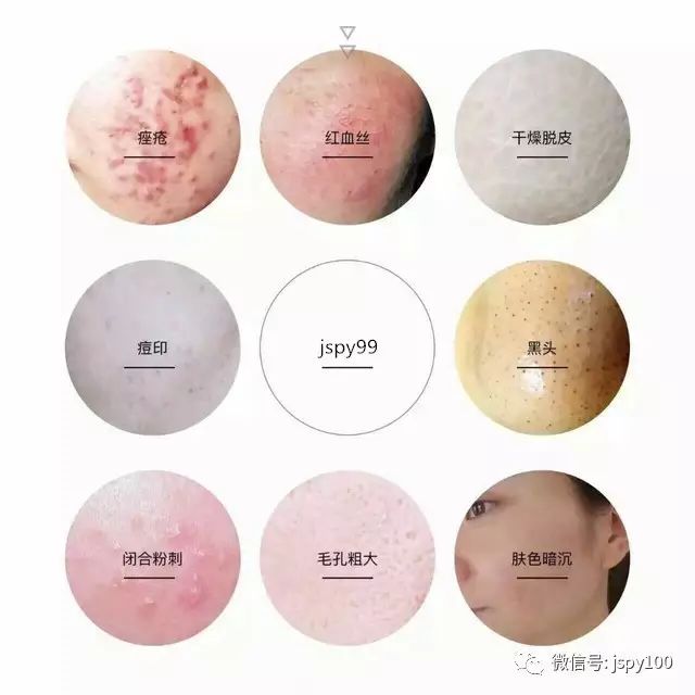 你知道什么是激素脸吗