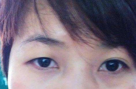 明显双眼皮注意事项,单双眼皮会变成恐怖的阴阳眼吗