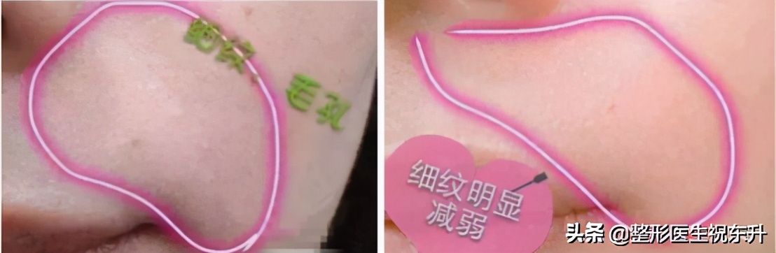 水光针打基础的有啥效果,脸上扎20多针