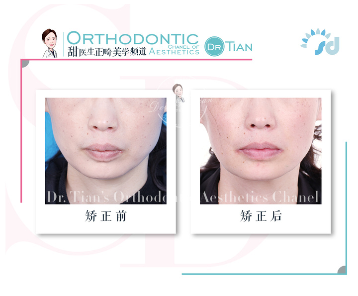 47岁大龄矫正,骨性嘴突+牙缝大+牙周炎|曹博士正畸复杂病例分享
