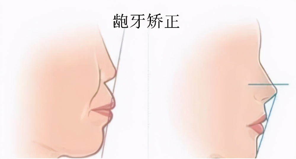 13岁儿童牙齿矫正龅牙前突,牙齿前突龅牙治疗过程