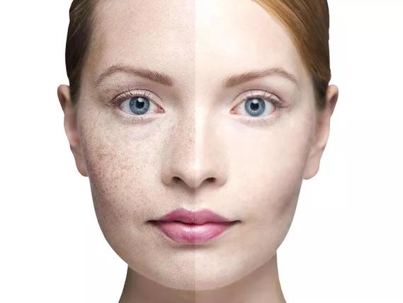 点阵激光祛痘印的副作用和危害,co2点阵激光危害