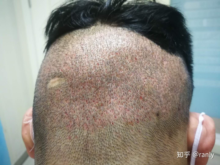 植发日记是什么,植发日记vlog第六天