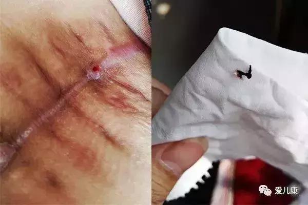 产后刀口又痒又痛的原因居然是这个?