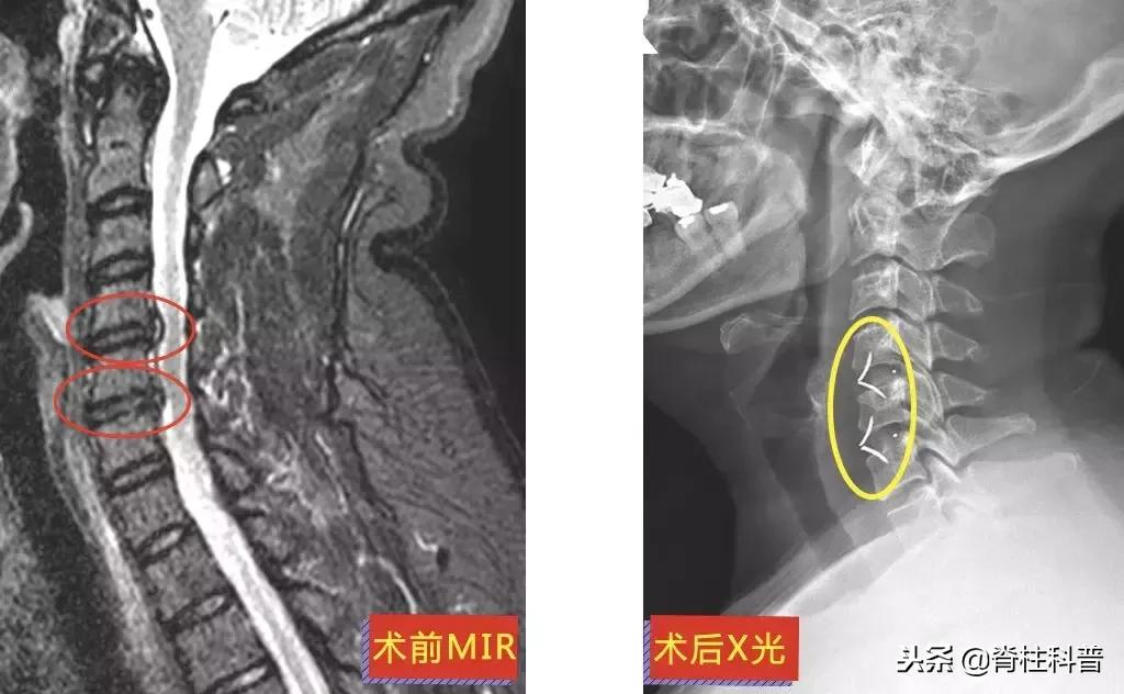 颈椎病治疗的分享,关于颈椎病通俗易懂的科普
