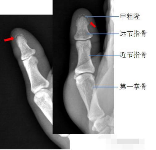 怎样发现骨折的可能性,一招看出手指骨折