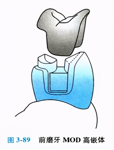 牙科嵌体的处理,牙科医生讲义