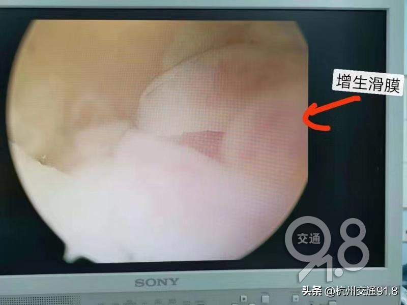 杭州老阿姨手肘关节突然疼得动不了了，医生手术取出了一团“海绵”……