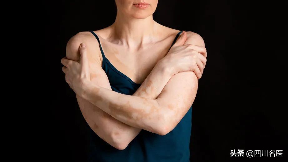 白癜风专家会诊,全国征集10名白癜风病友免费治疗