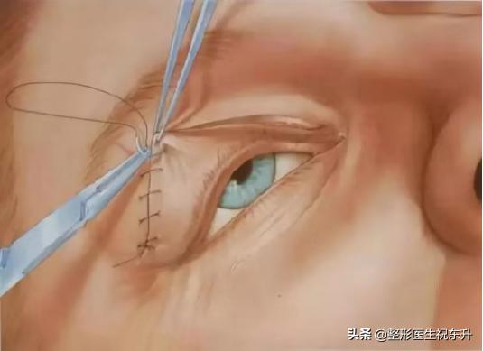 切开法双眼皮,切开双眼皮修复后多久可以再修