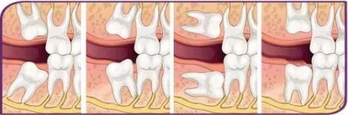 拔智齿花了260,拔智齿花了14800多