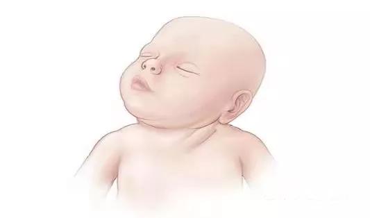 宝宝脖子歪向一边长大会自己好吗,小孩突然脖子歪一边痛什么原因
