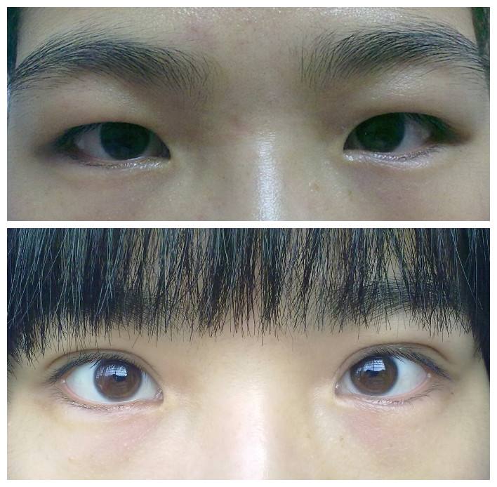 双眼皮不要盲目跟风,别割双眼皮