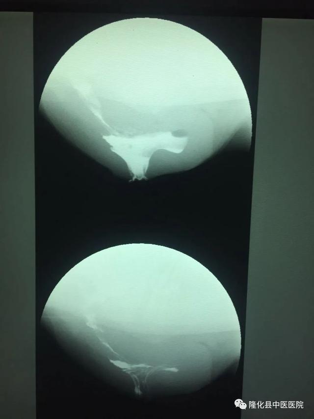 疫情防控和医疗服务两手抓—承德市—隆化县中医院肛肠脾胃病科再添直肠排便造影新技术,填补隆化县空白!