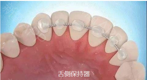 所有矫正都要戴保持器吗,成年人矫正牙齿需要戴保持器多久