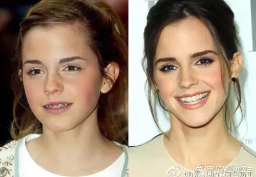 笑起来露牙龈怎么解决,笑露牙龈矫正大概得要多少钱