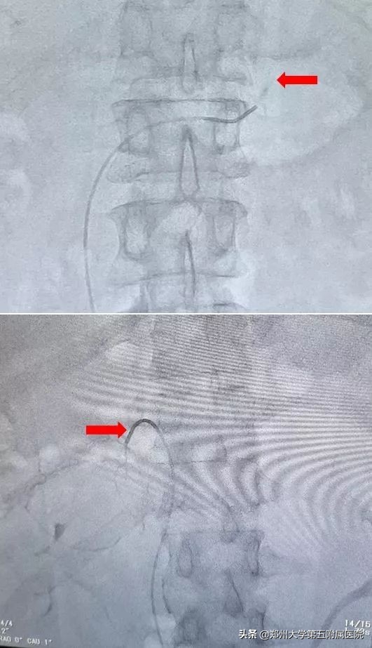 郑州大学五附院成功开展3例肾上腺静脉取血术