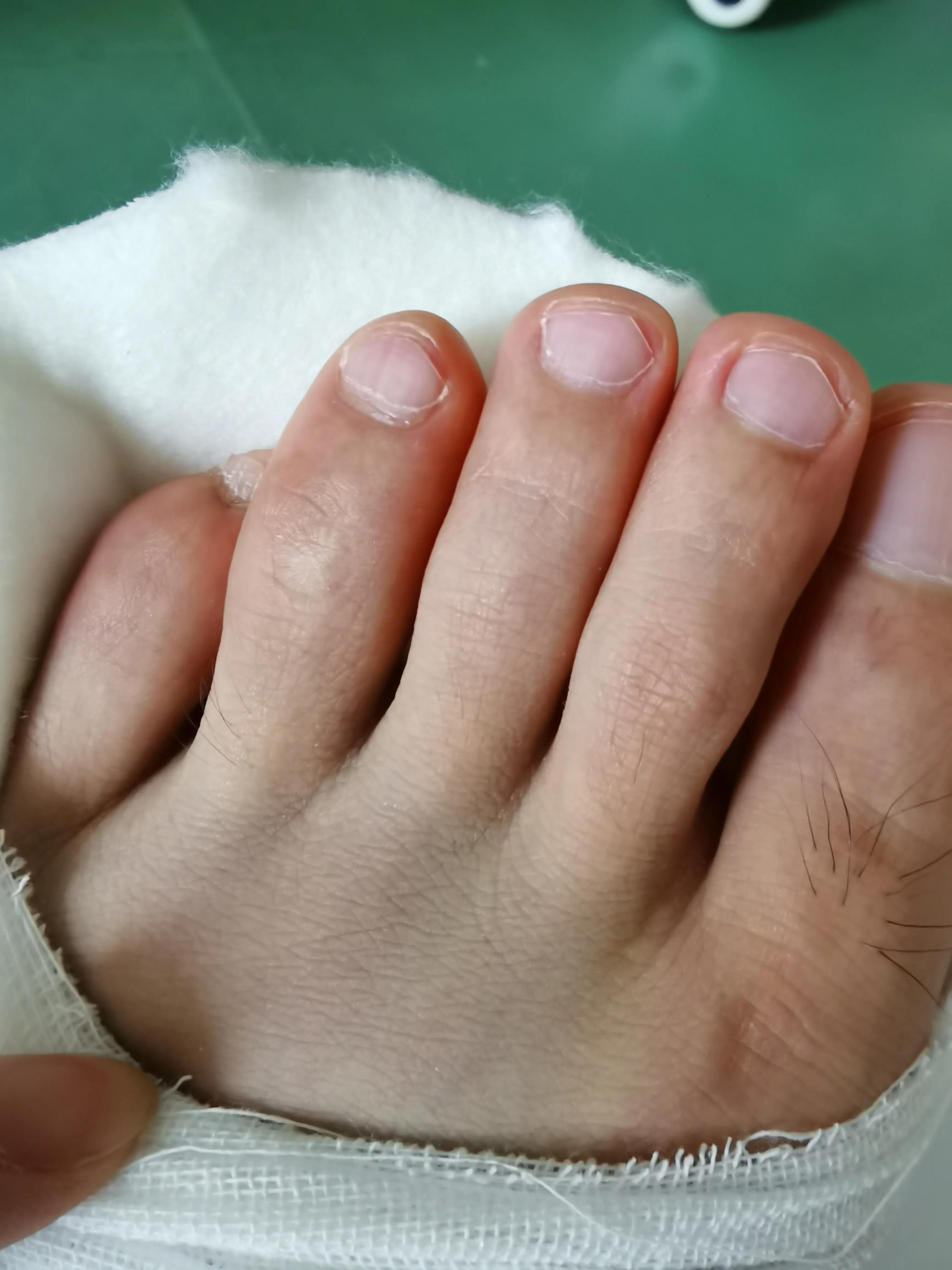 第五跖骨粉碎性骨折多久后能走路,第五跖骨基底骨折100天了走路肿