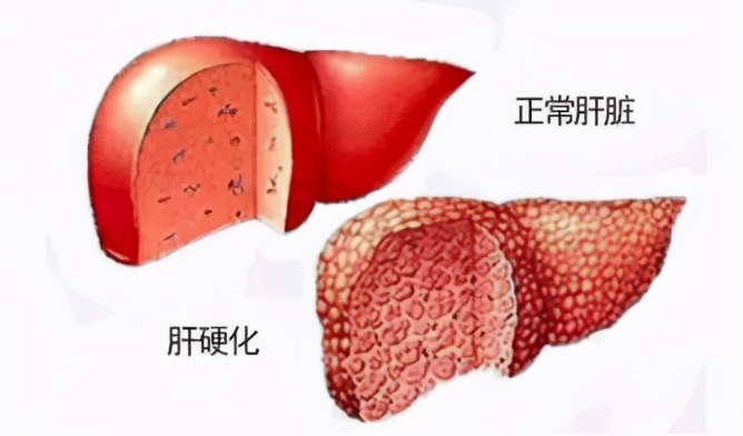 乙肝有康复的案例吗,乙肝康复案例