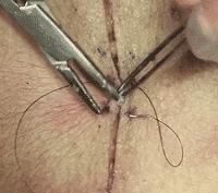 十种外科基本缝合方式详解,手术切口缝合有哪几种