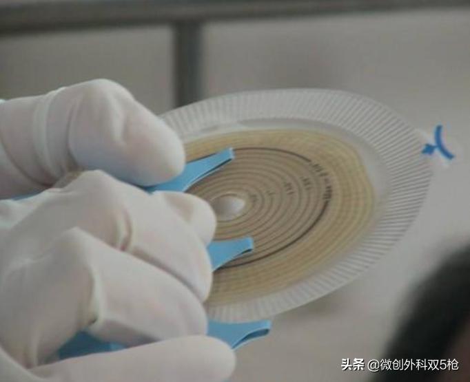 直肠癌手术结肠造口还是回肠造口,直肠癌造口后还需要做肠镜